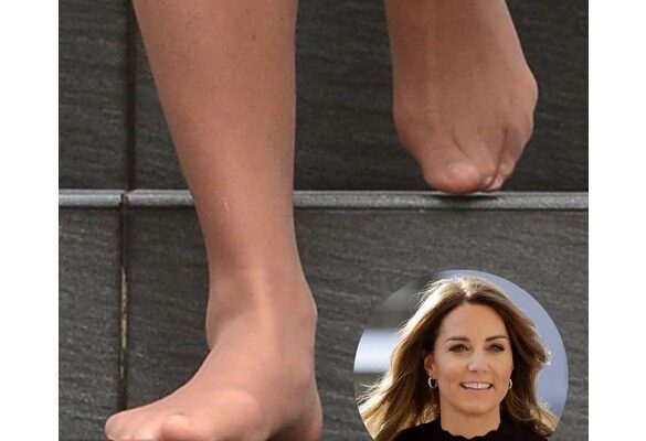 Stealing the Spotlight: Celebrities with bunions
